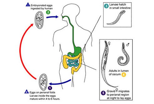 Pinworm parazita orvoslás